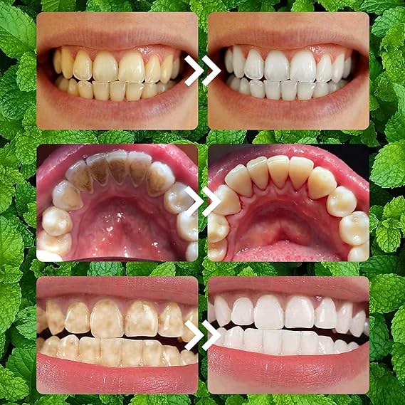 LumiDent Pro® – Pó Dental Mineral  Clareamento Profundo e Restauração do Esmalte